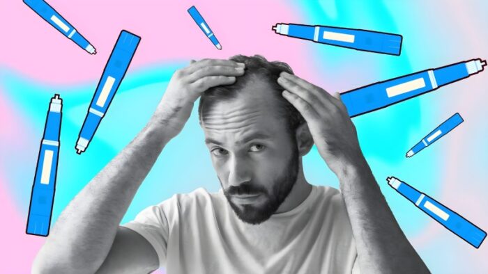 داروهای لاغری GLP-1 و ریزش مو؛ آیا اوزمپیک و ویگووی باعث کم پشت شدن مو میشوند؟