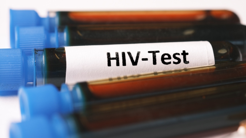 چه زمانی باید آزمایش HIV انجام دهیم؟